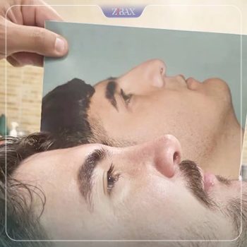 نمونه کار جراحی بینی دکتر آزاده مرادی