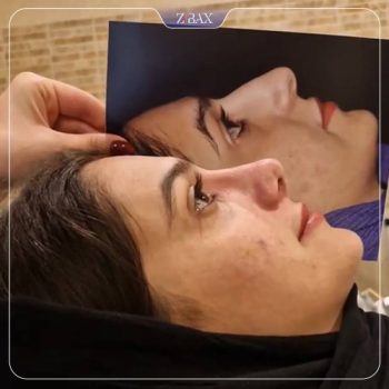 نمونه کار جراحی بینی دکتر آزاده مرادی