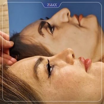 نمونه کار جراحی بینی دکتر آزاده مرادی