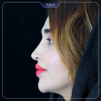 نمونه جراحی بینی با دکتر ابراهیم حاتمی پور در شیراز