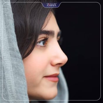 عکس نمونه کار جراحی بینی با دکتر ابراهیم حاتمی پور در شیراز