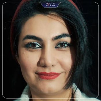 عکس جراحی زیبایی بینی توسط دکتر ابراهیم حاتمی پور در شیراز