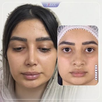 نمونه کار جراحی بینی دکتر ادیب مولایی