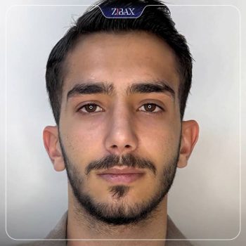 نمونه کار جراحی بینی دکتر ادیب مولایی