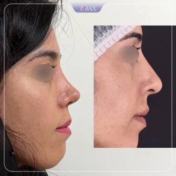 نمونه کار جراحی بینی دکتر ادیب مولایی