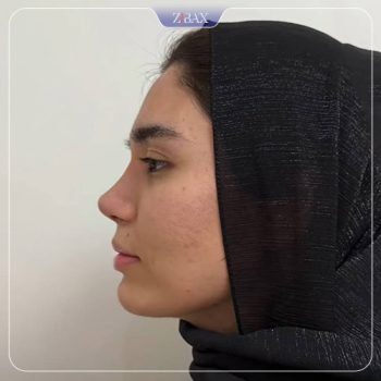 نمونه کار جراحی بینی دکتر ادیب مولایی