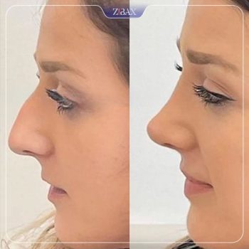 نمونه کار جراحی بینی دکتر اردلان دهقانی 1