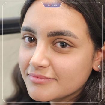 نمونه جراحی بینی با دکتر امیر خسرو برخورداری در شیراز