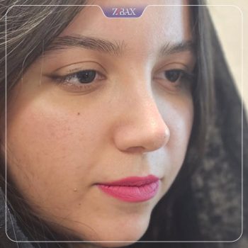 عکس نمونه کار جراحی بینی با دکتر امیر خسرو برخورداری در شیراز