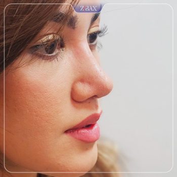 جراحی بینی توسط دکتر امیر خسرو برخورداری در شیراز