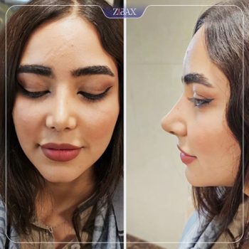 نمونه جراحی زیبایی بینی با دکتر امیر خسرو برخورداری جراح بینی شیراز