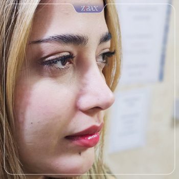 نمونه کار عمل زیبایی بینی دکتر امیر خسرو برخورداری در شیراز