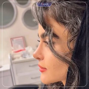 نمونه کار جراحی بینی دکتر اکبر اعتمادی
