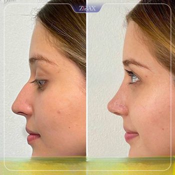 نمونه کار جراحی بینی دکتر اکبر اعتمادی