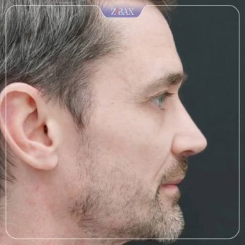 نمونه کار جراحی بینی دکتر حامد محمدی