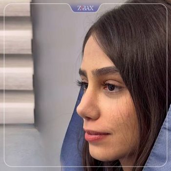 نمونه جراحی بینی با دکتر حامد عباسی در تهران
