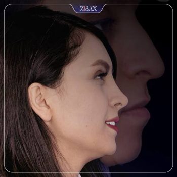 نمونه جراحی بینی با دکتر حامد عباسی در تهران