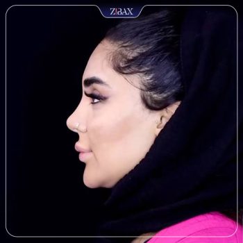 نمونه جراحی زیبایی بینی با دکتر حامد عباسی جراح بینی تهران