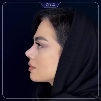 نمونه کار عمل زیبایی بینی دکتر حامد عباسی در تهران