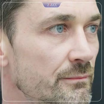 نمونه کار جراحی بینی دکتر حامد محمدی