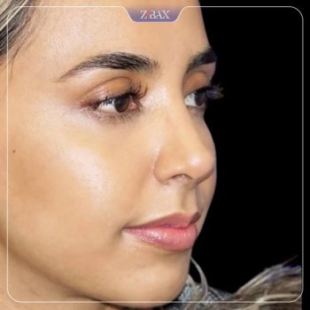 نمونه کار جراحی بینی دکتر حامد محمدی