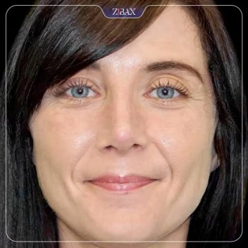 نمونه کار جراحی بینی دکتر حامد محمدی