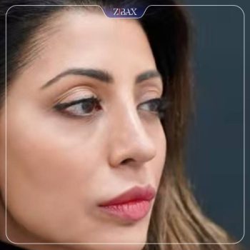 نمونه کار جراحی بینی دکتر حامد محمدی