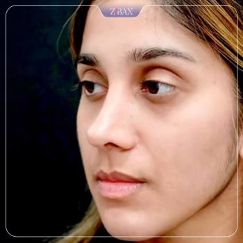 نمونه کار جراحی بینی دکتر حامد محمدی