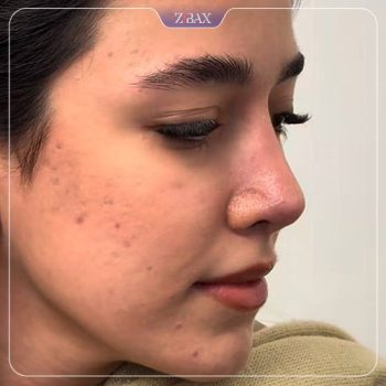 نمونه کار جراحی بینی دکتر 1حتمد پوستچی