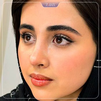 نمونه کار جراحی بینی دکتر حامد پوستچی