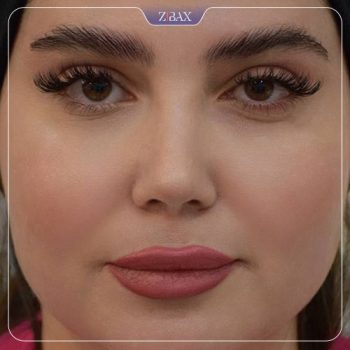 نمونه کار جراحی بینی دکتر حامد پوستچی