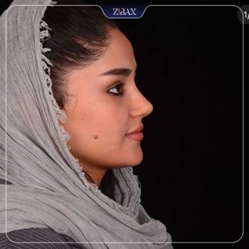 نمونه کار جراحی بینی دکتر حامد پوستچی