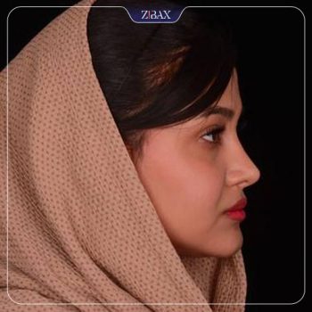 نمونه کار جراحی بینی دکتر حامد پوستچی