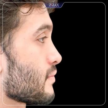 نمونه کار جراحی بینی دکتر حامد محمدی