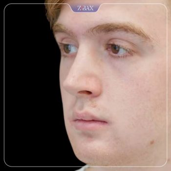 نمونه کار جراحی بینی دکتر حامد محمدی