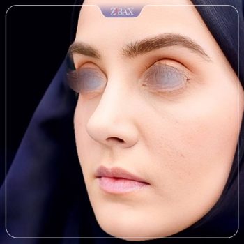 نمونه کار جراحی بینی دکتر حامد محمدی