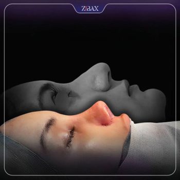 نمونه کار عمل زیبایی بینی دکتر حسین مرادیان در شیراز