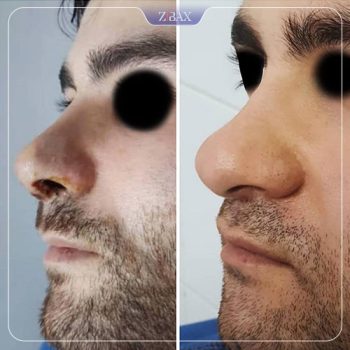 نمونه کار جراحی بینی دکتر حشمت الله حقوقی