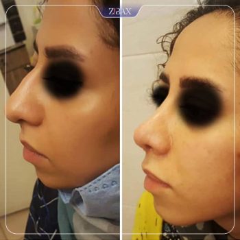 نمونه کار جراحی بینی دکتر حشمت الله حقوقی