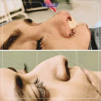 نمونه کار جراحی بینی دکتر حشمت الله حقوقی