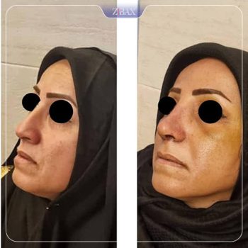 نمونه کار جراحی بینی دکتر حشمت الله حقوقی
