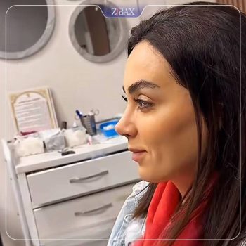 نمونه عمل زیبایی بینی دکتر خسرو مقتدر تهران