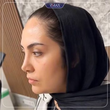 عکس نمونه کار جراحی بینی با دکتر خسرو مقتدر در تهران