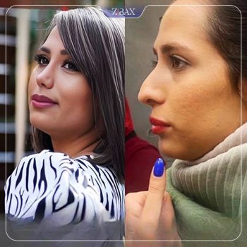 تصویر عمل زیبایی بینی با دکتر خسرو مقتدر در تهران