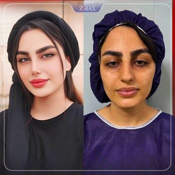 نمونه کار عمل زیبایی بینی دکتر خسرو مقتدر در تهران