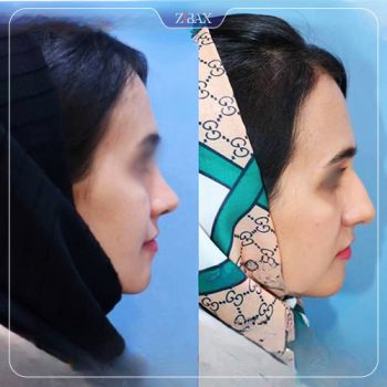 نمونه عمل زیبایی بینی دکتر داریوش ساریخانی شیراز