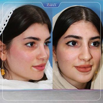 عکس جراحی زیبایی بینی توسط دکتر داریوش ساریخانی در شیراز
