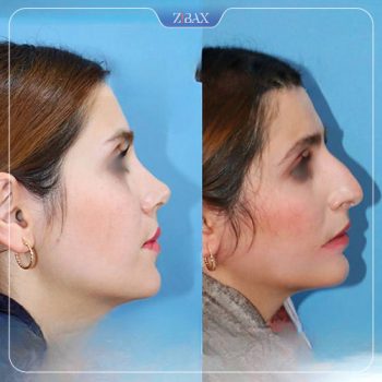 تصویر عمل زیبایی بینی با دکتر داریوش ساریخانی در شیراز