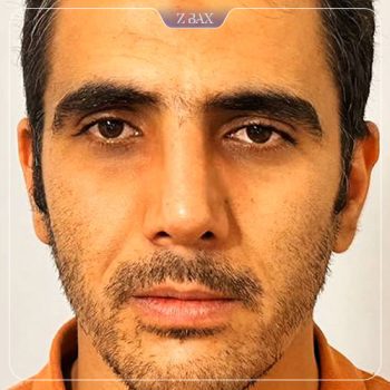 نمونه کار جراحی بینی دکتر رضا سید محمد
