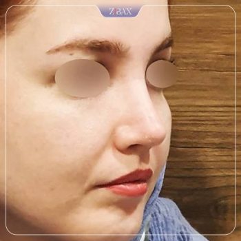 نمونه جراحی بینی با دکتر رضا کبودخانی در شیراز